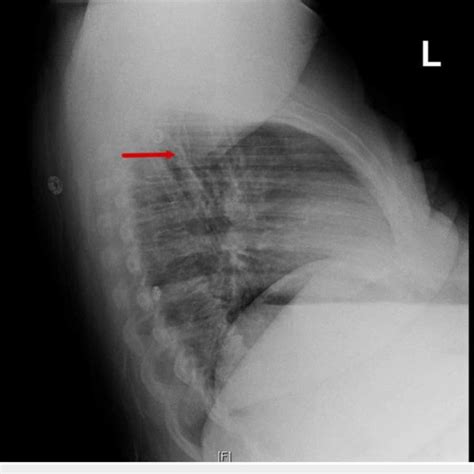 Lateral View Of Chest X Ray With Findings Suspicious For Right Upper