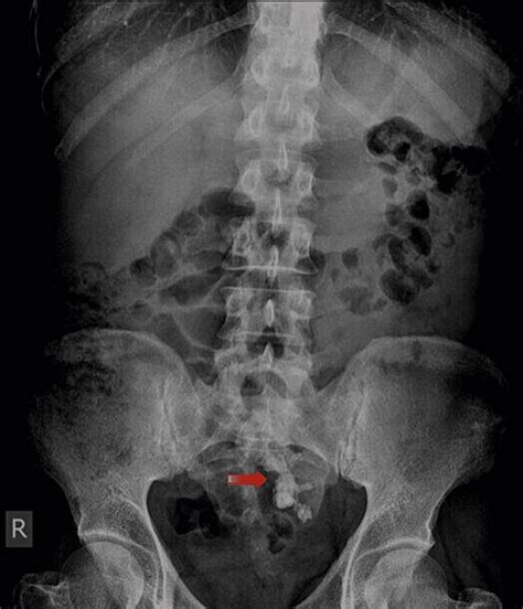 Cureus Laparoscopy Assisted Percutaneous Nephrolithotripsy Pcnl In