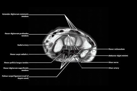 Mri Hand