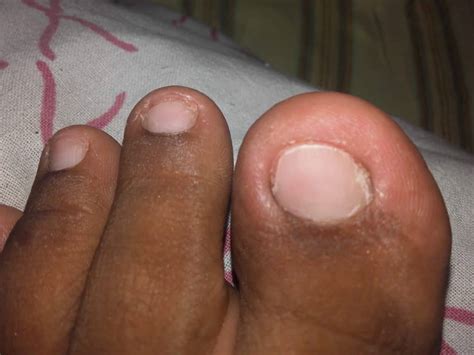 Steps on How to use Floss to Fix an Ingrown Toenail (with ...