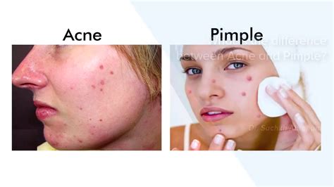 Difference Between Acne And Pimple Top Skin Specialist In Bangalore
