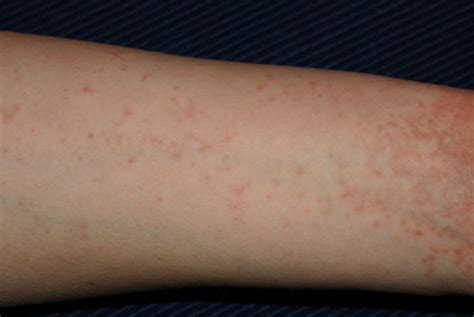 Rashes That Look Like Scabies Causes Symptoms And Off