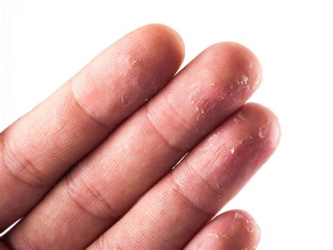 Skin Peeling On Fingertips 10 Causes