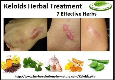 Natural Herbal Treatment For Keloids Herbs Solutions By Nature Blog