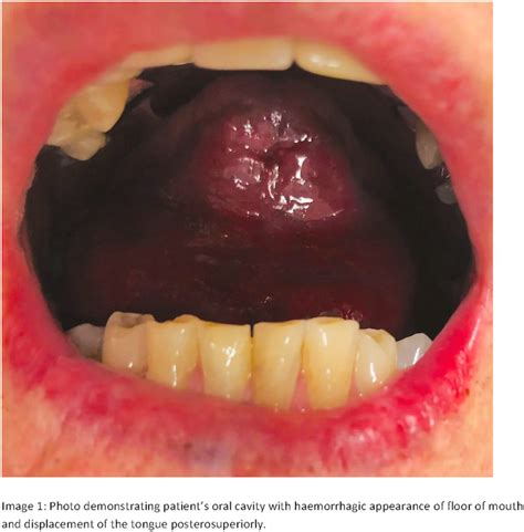 Surgical Drainage Of Spontaneous Sublingual Haematoma Bmj Case Reports