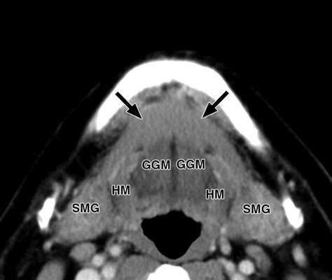 Imaging Of The Mylohyoid Muscle Separation Of Submandibular And