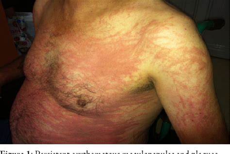 Figure From Atypical Skin Rash In A Patient With Adult Onset Still S Disease A Case Report