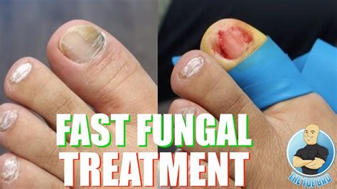 Best Medicine For Fungal Infection Nails Medicinewalls
