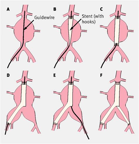The Management Of Abdominal Aortic Aneurysms The Bmj