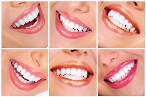 New Smile Dental: Brighten Your Smile with Teeth Whitening from Dr. Lopez