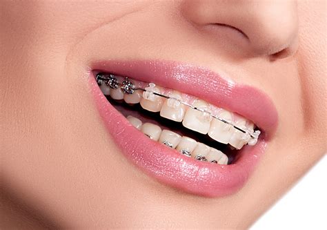 Top Notch Dental Braces Procedure For Fallbrook California