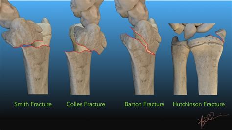 Colles Fracture Causes Symptoms Diagnosis Treatment Rxharun