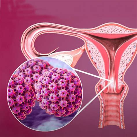 campanha de conscientização sobre o câncer do colo do útero