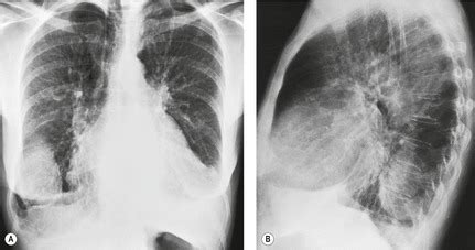 A pleural effusion is an abnormal buildup of fluid around your lungs, between the layers of tissue that line the lungs and chest cavity. 15. Pleura and pleural disorders | Radiology Key