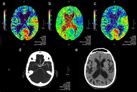 Ct Perfusion In Acute Stroke Calls A Pictorial Review And Differential