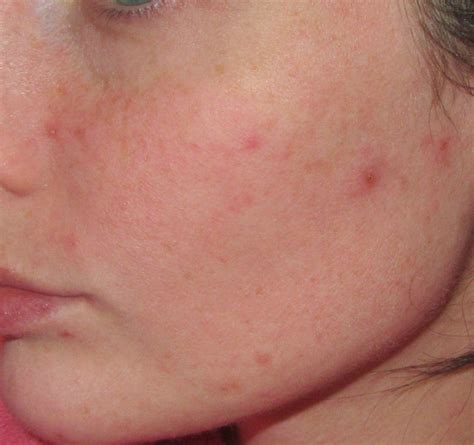 Home Remedies To Treat Rashes On The Face Face Rash Remedies Rash On