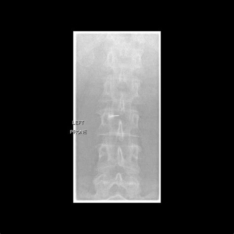 Fluoroscopy Guided Lumbar Puncture Pacs