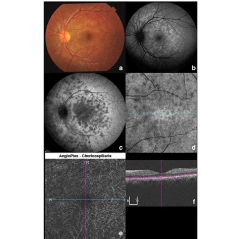 Fundus Autofluorescence Of The Left Eye Of A Patient With Active Azoor