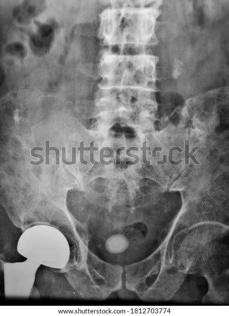 Urinary Bladder Stone Shown Xray Kub Stock Photo 1812703774 Shutterstock