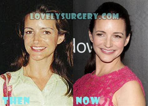 Kristin Davis Plastic Surgery Before And After Photos Lovely Surgery