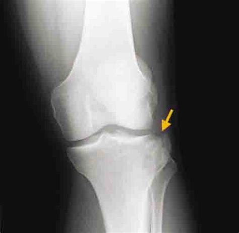 Anterior Tibial Plateau Fracture