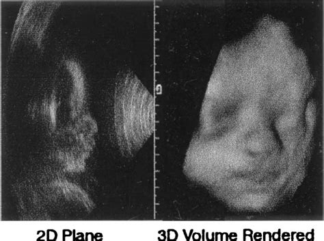 Pdf Three Dimensional Ultrasound Imaging Semantic Scholar