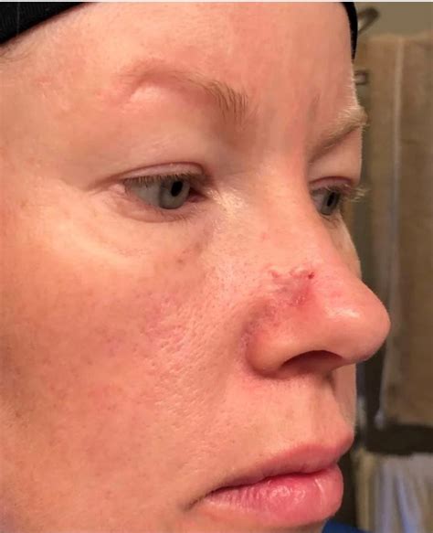 Acne Scar Turned Cancerous Left Gaping Hole In Nose Mouth Cancer