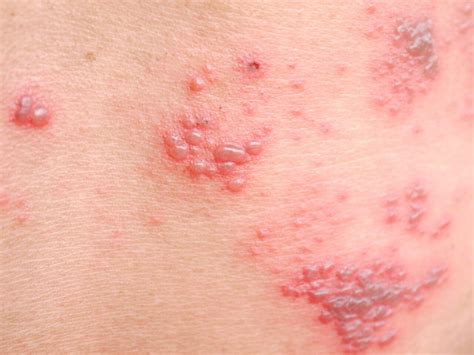 Dermatitis Herpetiformis Duhring Dh Příznaky Léčba Zdravověk