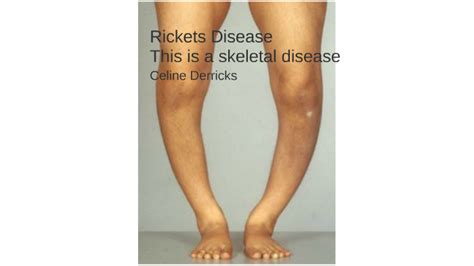 Rickets Disease By Celine Derricks