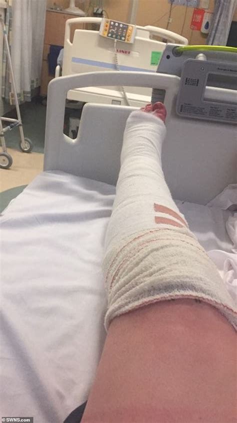 bride to be broke her leg in four places on her hen do daily mail online