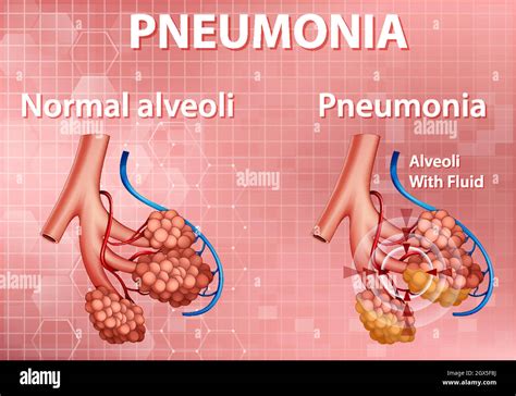 Human Anatomy Showing Pneumonia Stock Vector Image And Art Alamy