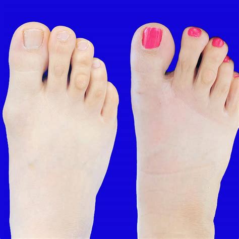 Theleafvacuum Surgery For Bunions Before And After