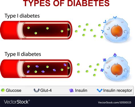 Diabetes type 1 and type 2 Royalty Free Vector Image