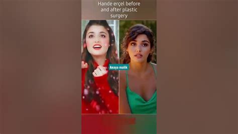 Hande Ercel Before And After Surgery Youtube
