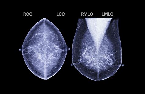 Yale Researchers Find More Women Receiving 3d Mammography Blue Cross