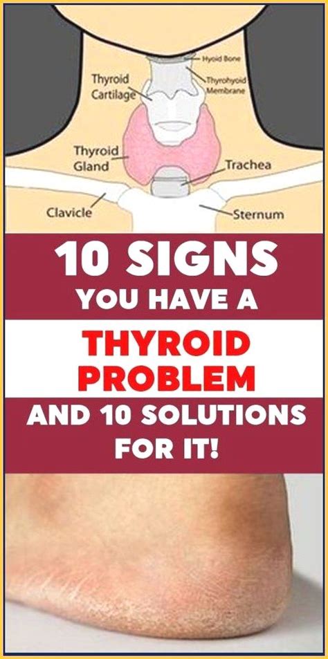 10 Signs You Have A Thyroid Problem And 10 Solutions For It Healthy