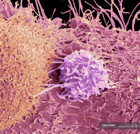 Coloured Scanning Electron Micrograph Of Surface Of Prostate Cancer