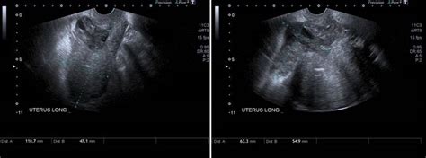 Transvaginal Ultrasound Depicts An Axial Section Of The Uterus A Images