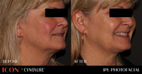 Ipl Before And After Photos Southeastern Dermatology