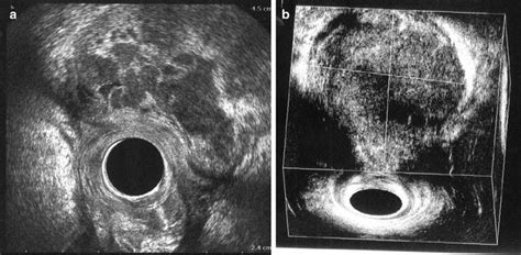 Endoanal Ultrasonographic Imaging Of The Anorectal Cysts And Masses Radiology Key