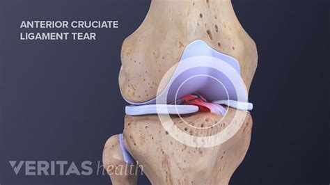 Anterior Cruciate Ligament Acl Tears