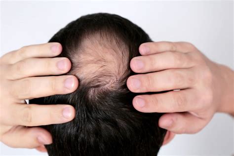 Baldness Hair Loss Man Head Hand Concerned Male Bald Wh