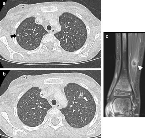 Disseminated Fungal Infection Trichosporonosis In A 6 Year Old Boy