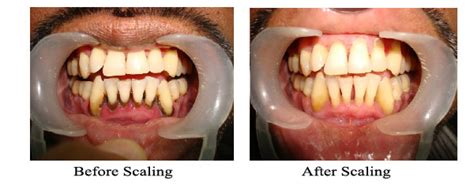 Klinik kesihatan kg.simee, jln komplek sukan, kg.simee, 31400 ipoh,perak tel : KLINIK PERGIGIAN SYARIFAH: FAQ cuci gigi (scaling)