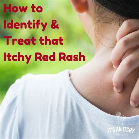 How To Identify And Treat That Itchy Red Rash Red Rash Skin Rashes
