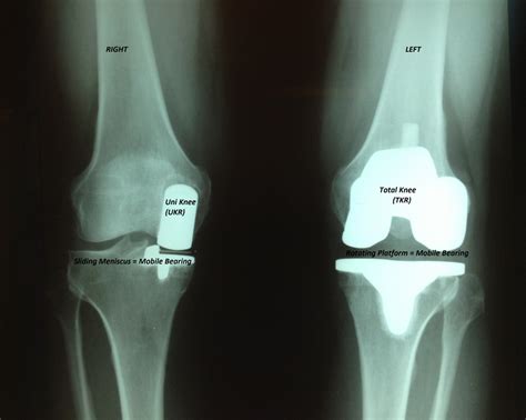 Advances In Knee Replacement Scottsdale Joint Center