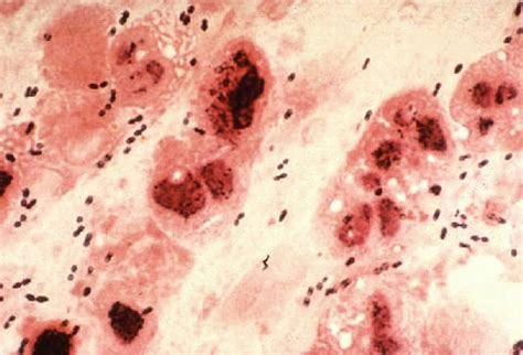 Neisseria meningitidis gram stain streptococcus pneumoniae gram stain neisseria meningitidis shaken baby syndrome haemophilus influenzae. Sputum smear Streptococcus pneumoniae/PMN pneumoniae (Dr ...