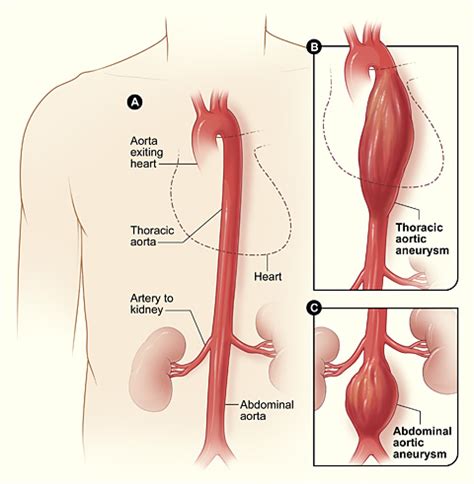 Thoracic Aortic Aneurysms Concise Medical Knowledge