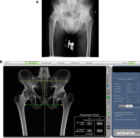 Preoperative X Rays And Three Dimensional Model Construction Of The