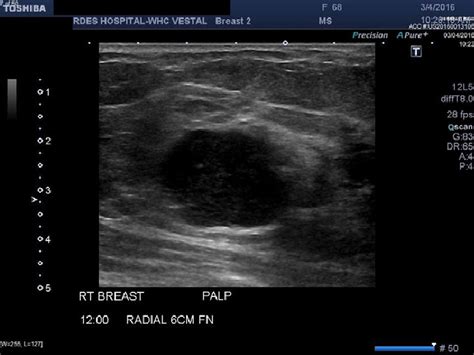 Right Breast Ultrasound Demonstrates An Irregular Shaped Hypoechoic